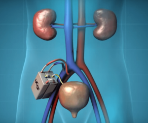 US scientists design an artificial kidney with Nano filters that could replace dialysis