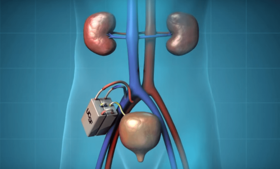 artificial kidney